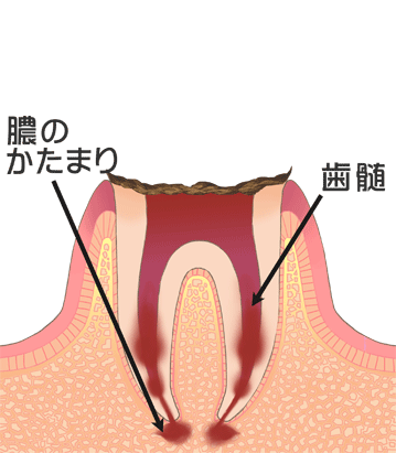 C4　歯の根の部分まで進行した虫歯