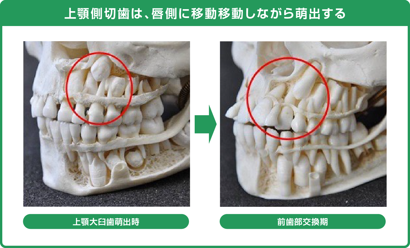 上顎側切歯は、唇側に移動移動しながら萌出する