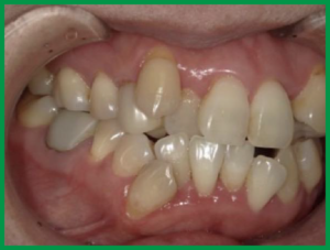悪い歯並びの例