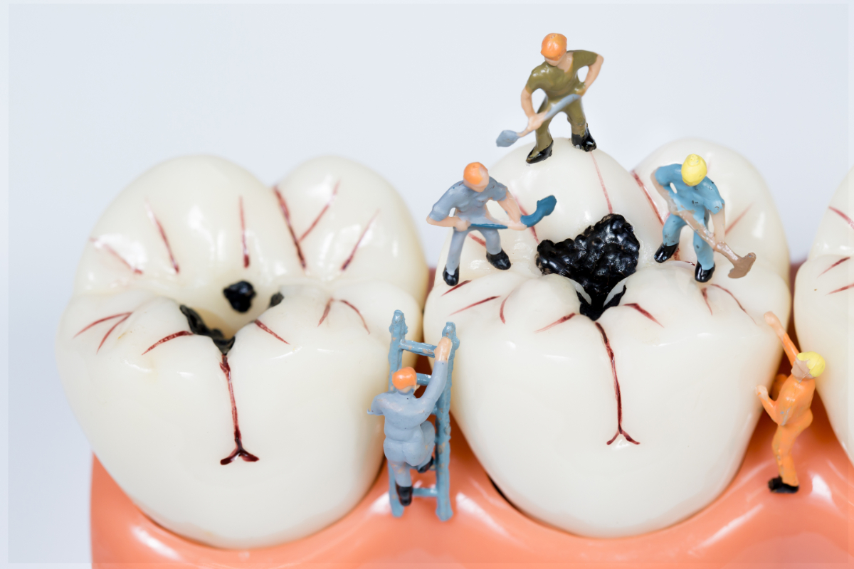 虫歯を治療するイメージ図