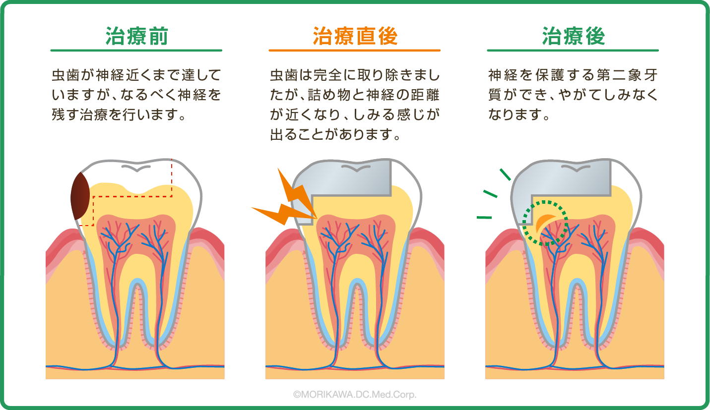 虫歯治療直後の痛み
