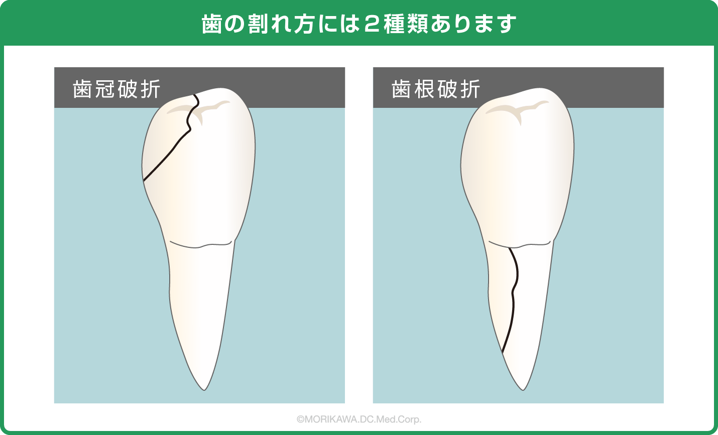 歯の割れ方には２種類あります