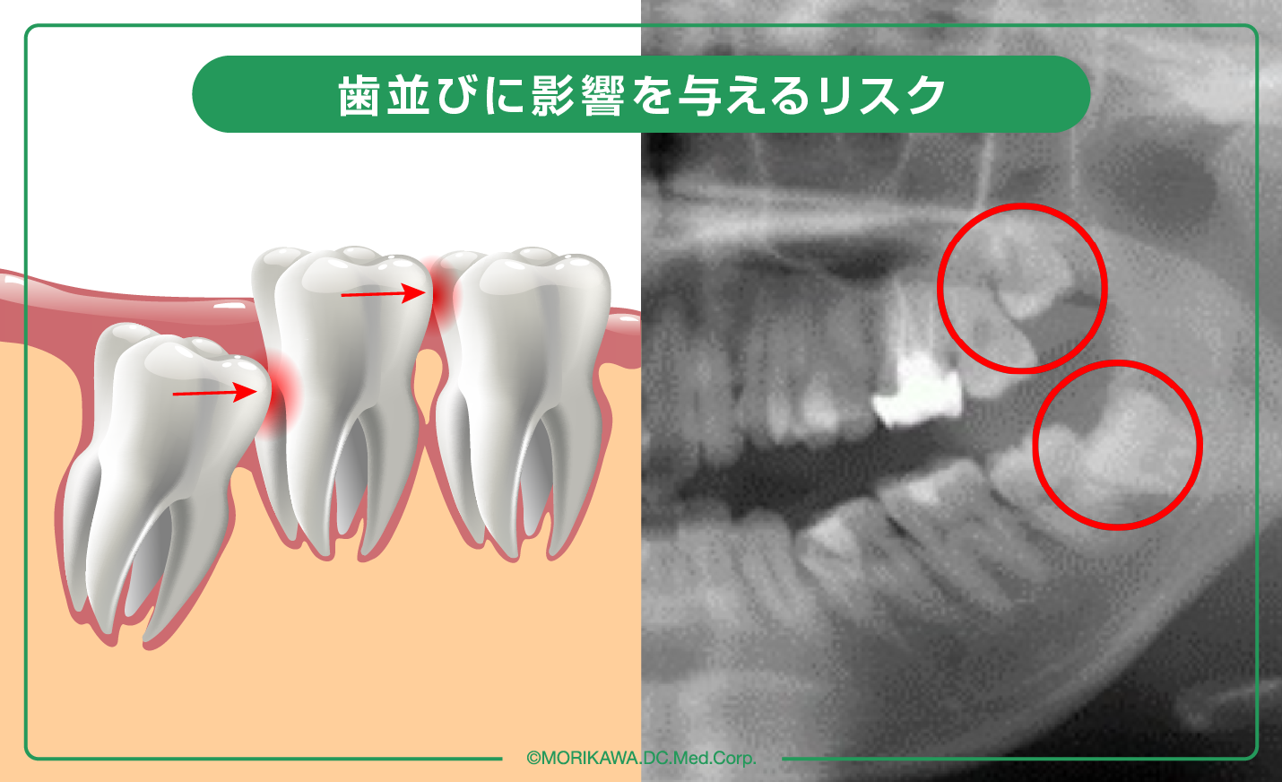 歯並びに影響を与えるリスク
