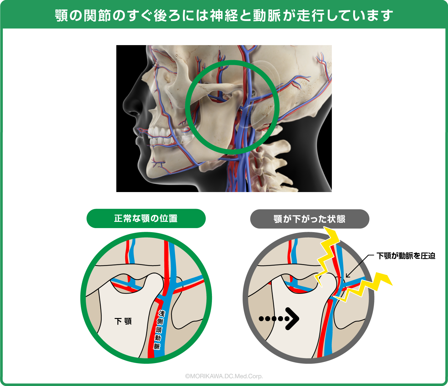 顎の関節のすぐ後ろには神経と動脈が走行しています