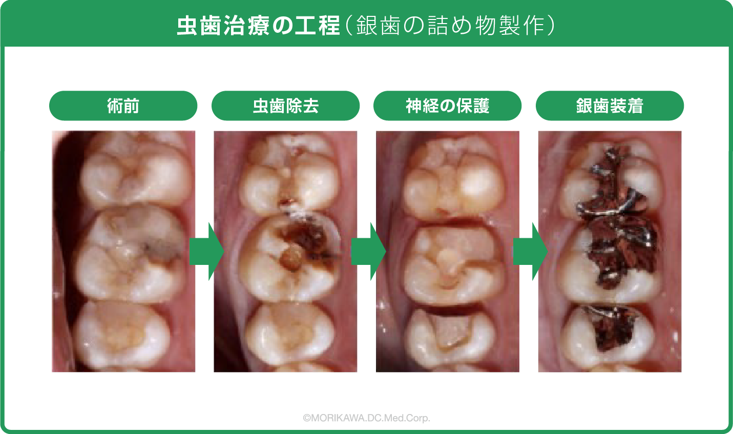 虫歯治療の工程（銀歯の詰め物製作）