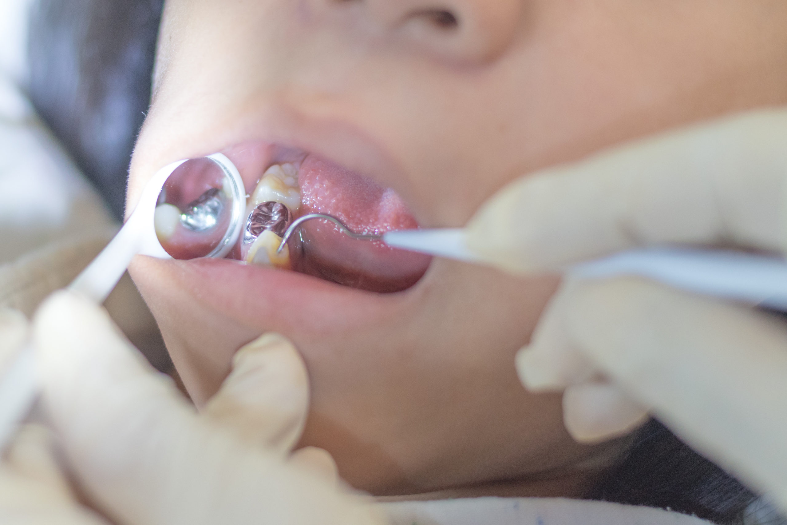 歯科用器具を使って銀歯の状態を確認するところ