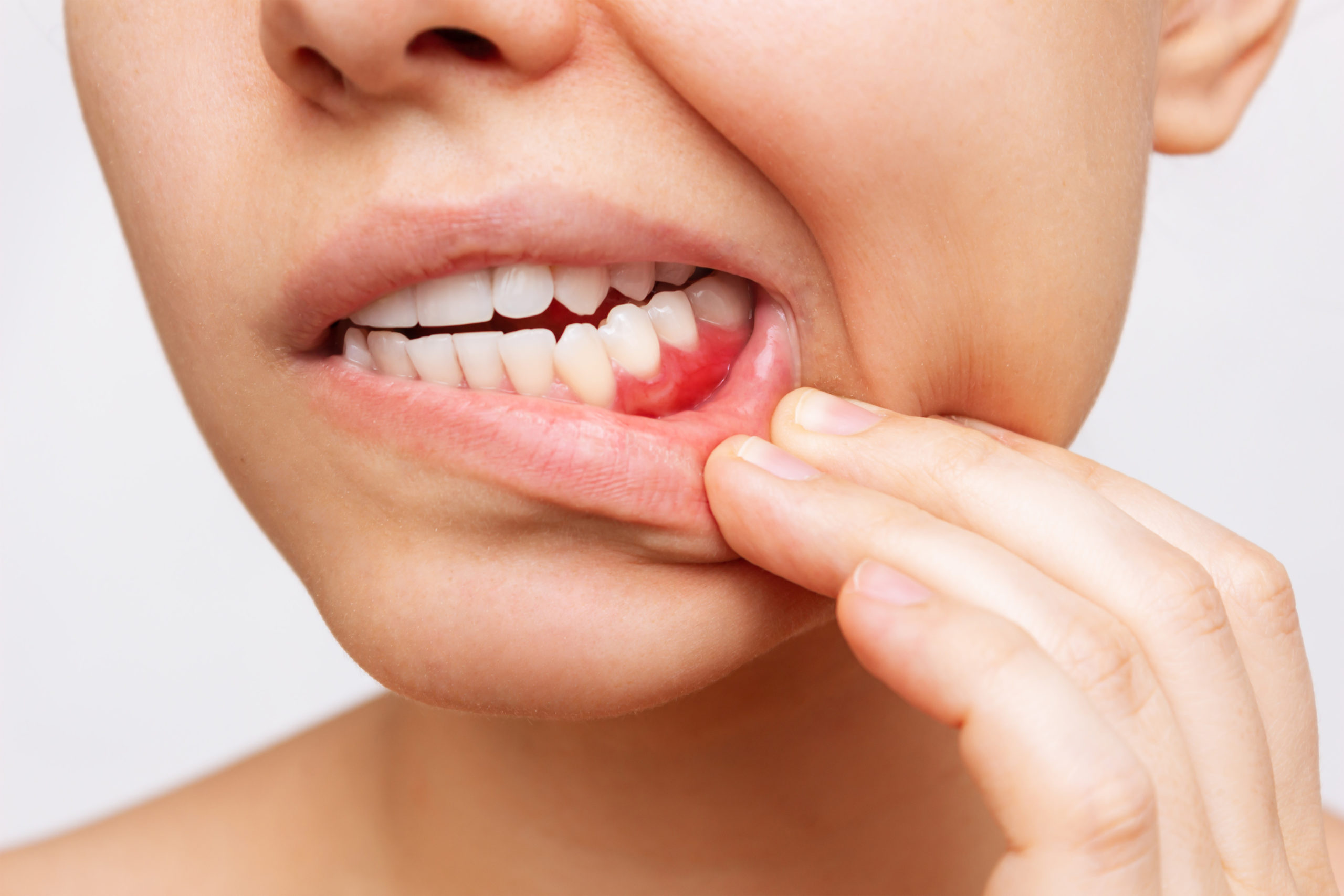 唇をめくって赤く腫れた歯茎を確認する人