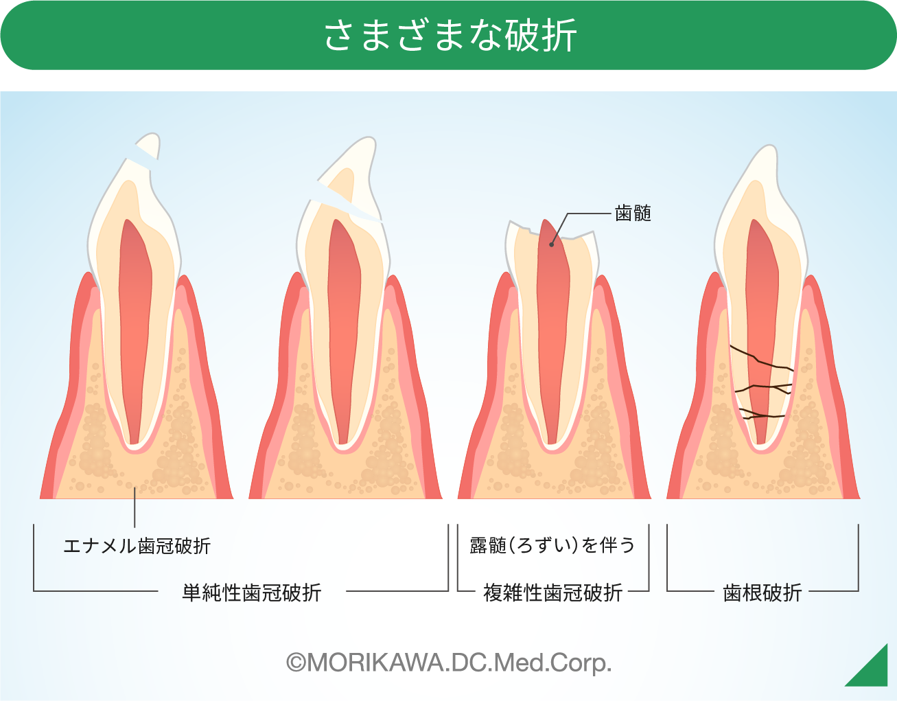 歯が欠けた!割れた!どうすればいいの?