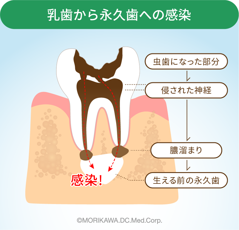 乳歯から永久歯への感染