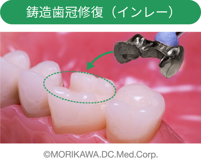 歯医者の保険適用範囲って?