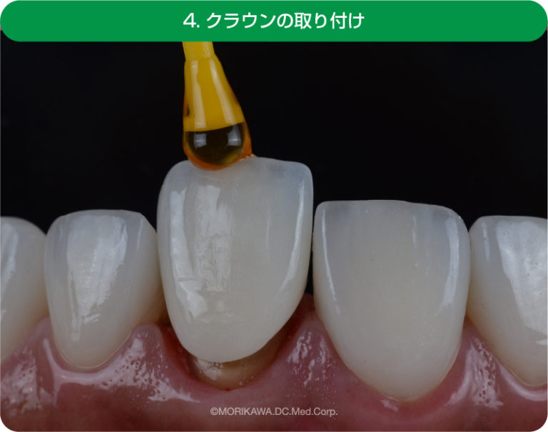 歯のクラウンの寿命は?