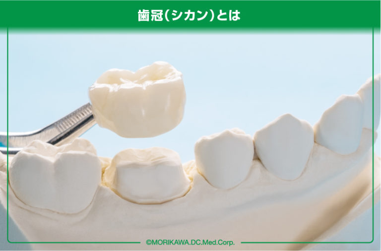 歯冠の被せ物の種類ってどんなものがある?徹底解説!