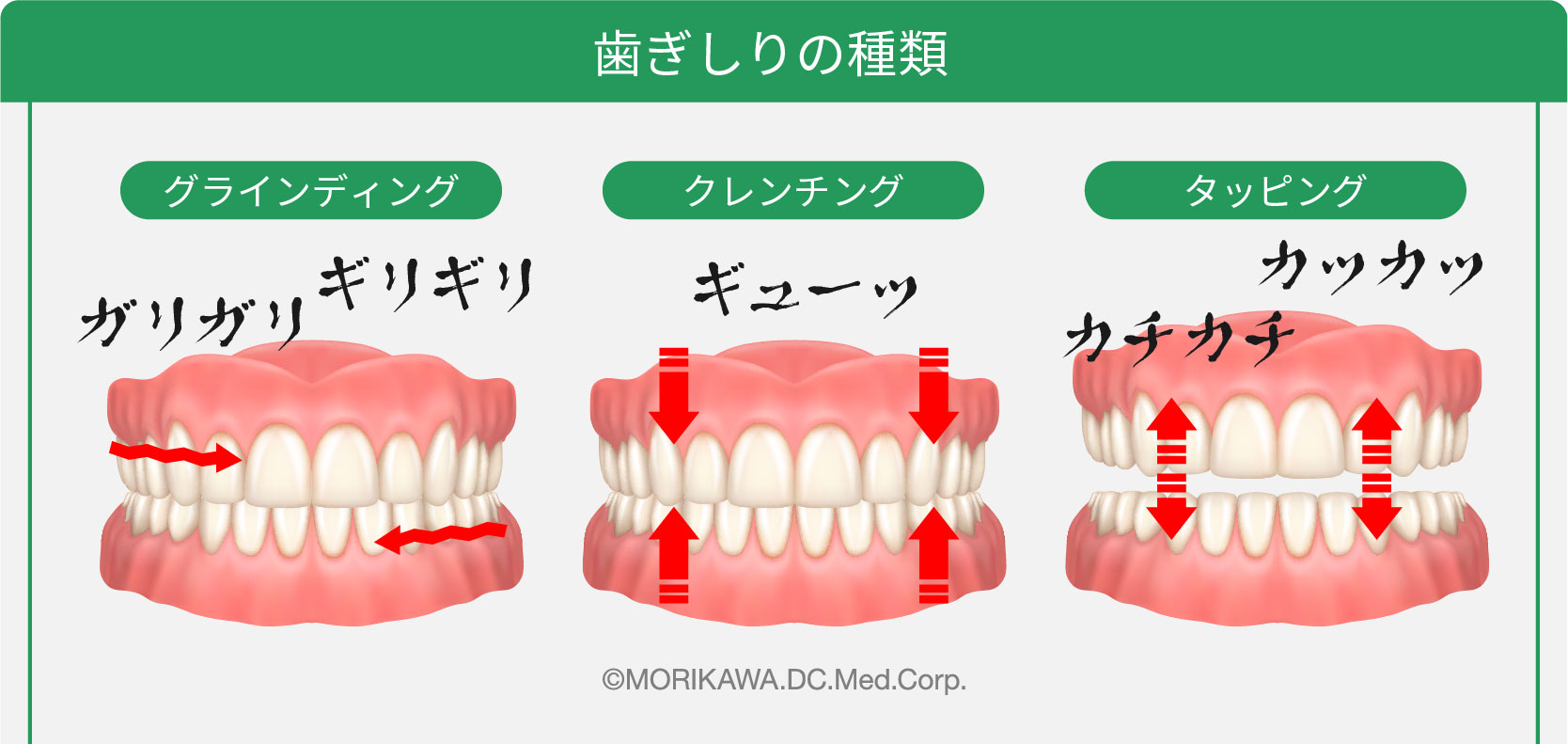 歯ぎしりの種類