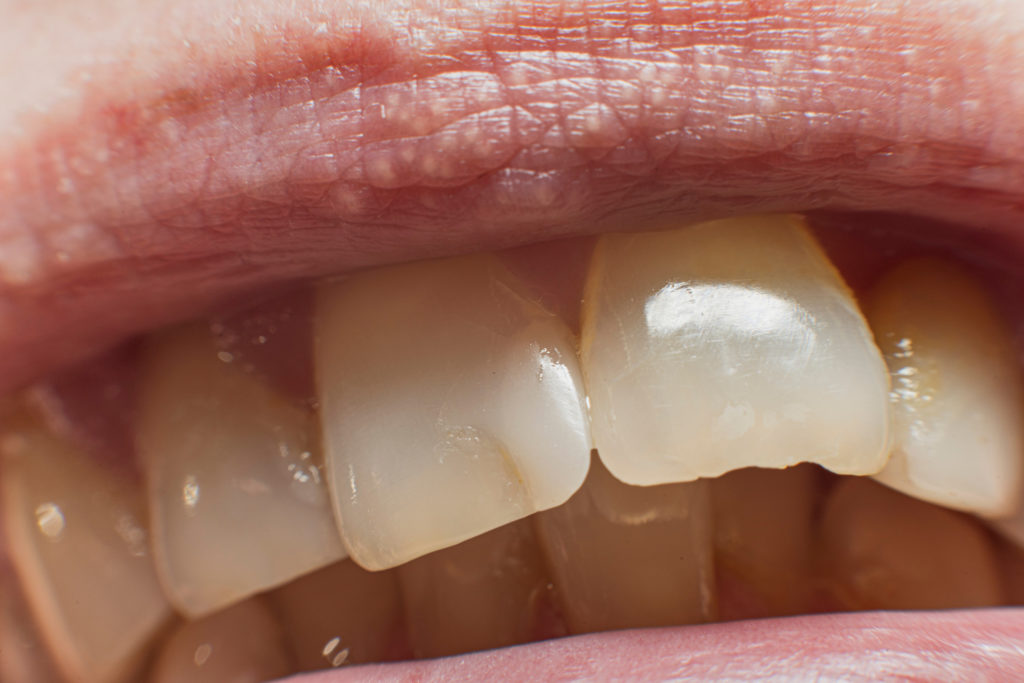 前歯の裏の虫歯
