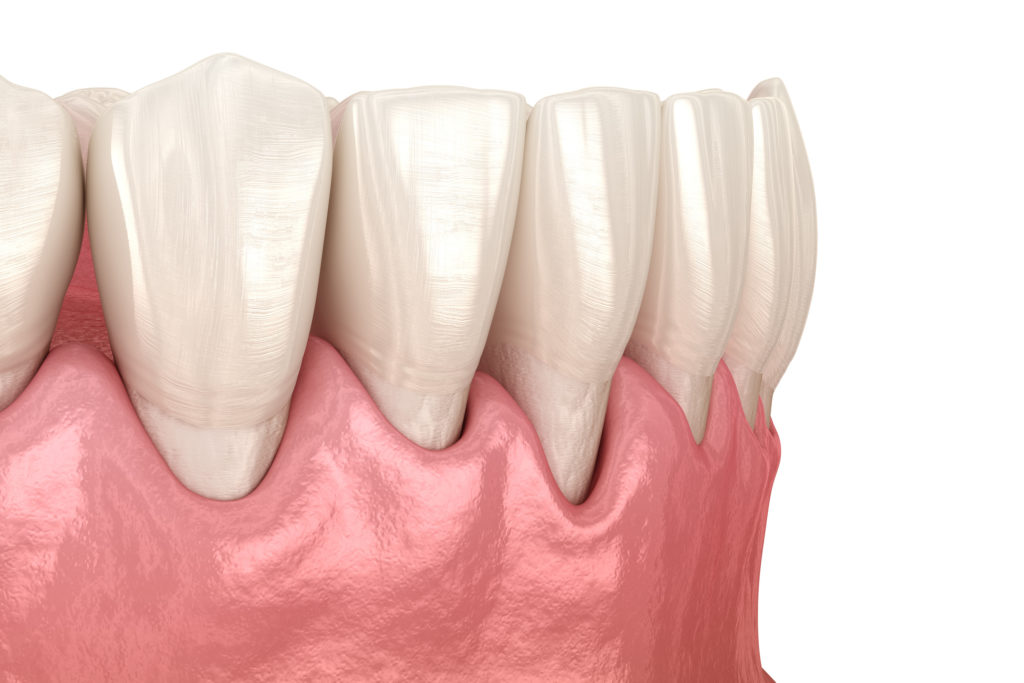 歯周病の歯