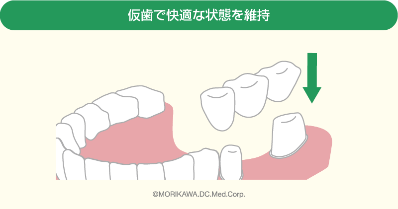 仮歯で快適な状態を維持