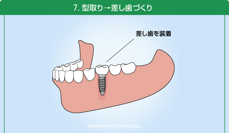 7.型取り→差し歯づくり