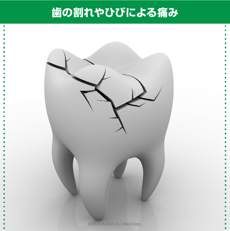 歯の割れやひびによる痛み