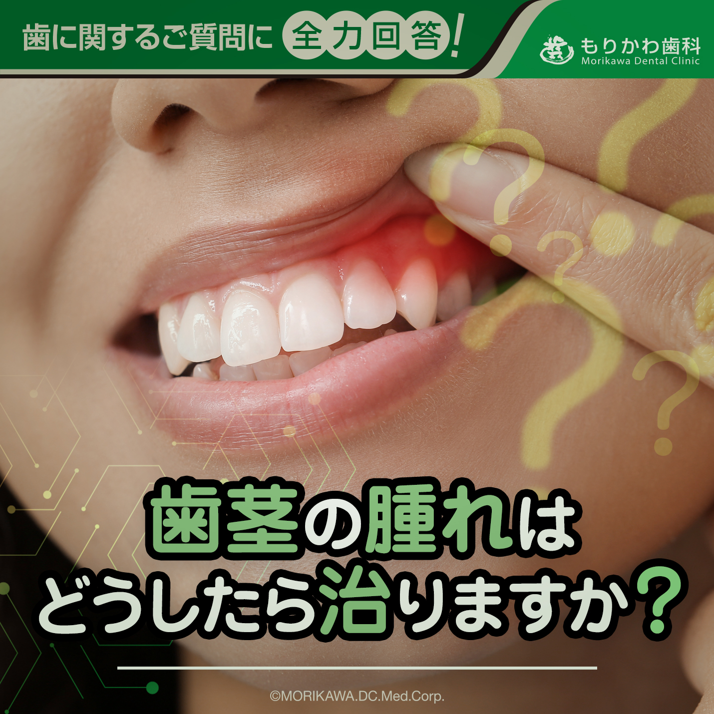 歯茎の腫れはどうしたら治りますか？