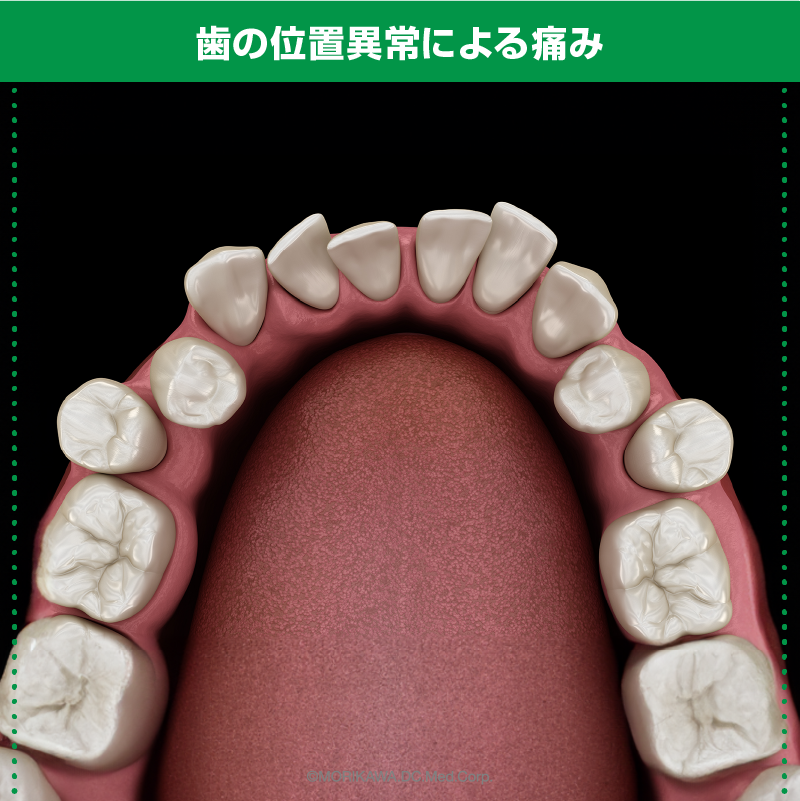歯の位置異常による痛み