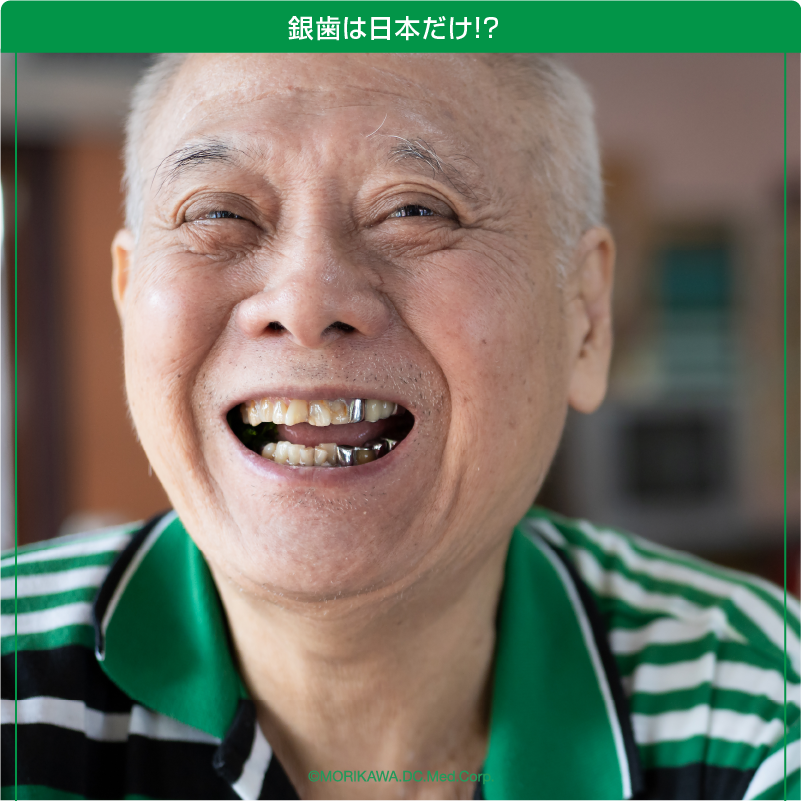 銀歯は日本人だけ？