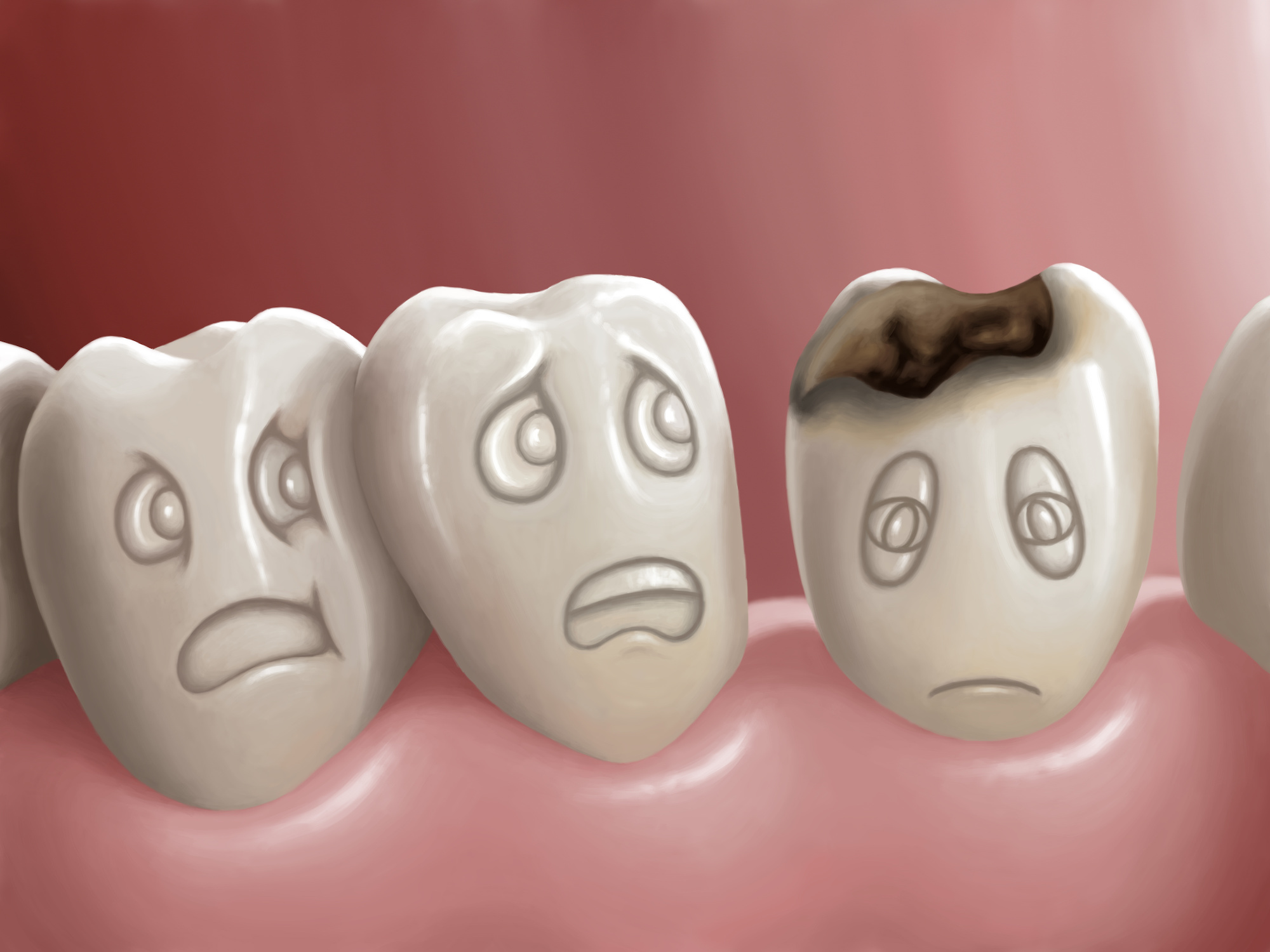 虫歯が再発するイメージ