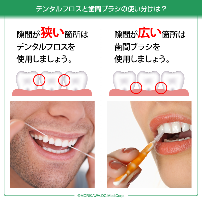 デンタルフロスと歯間ブラシの使い分けは?