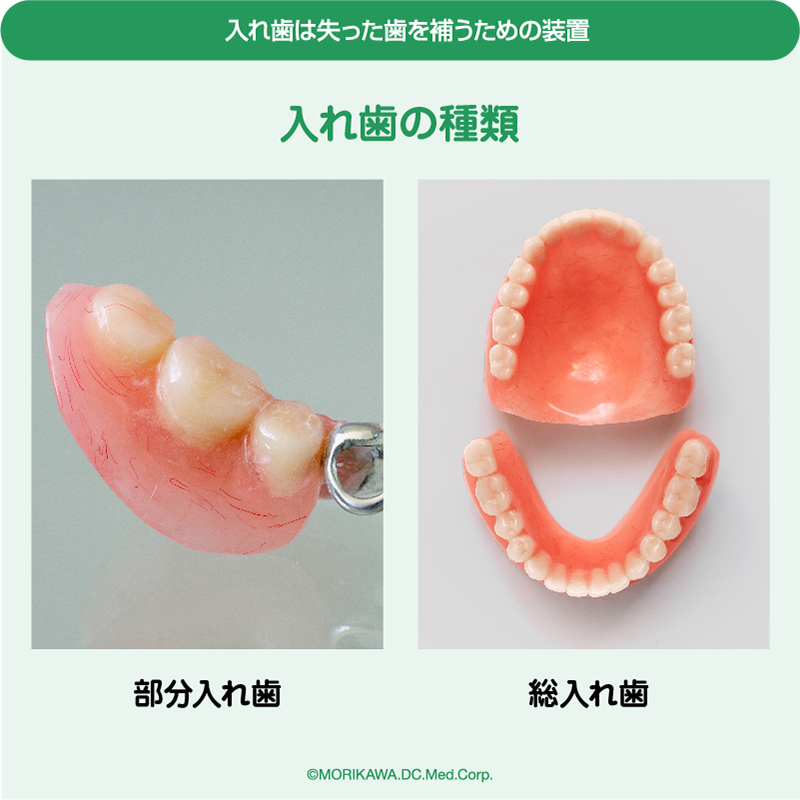 入れ歯は失った歯を補うための装置