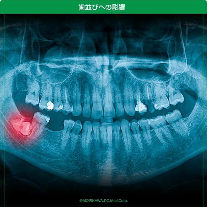 歯並びへの影響