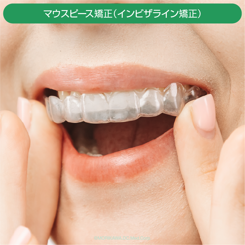 マウスピース矯正（インビザライン矯正）