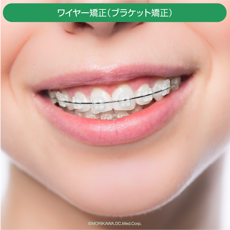 ワイヤー矯正 (ブラケット矯正)