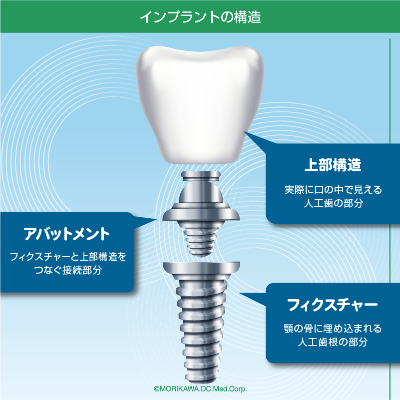 インプラントの構造