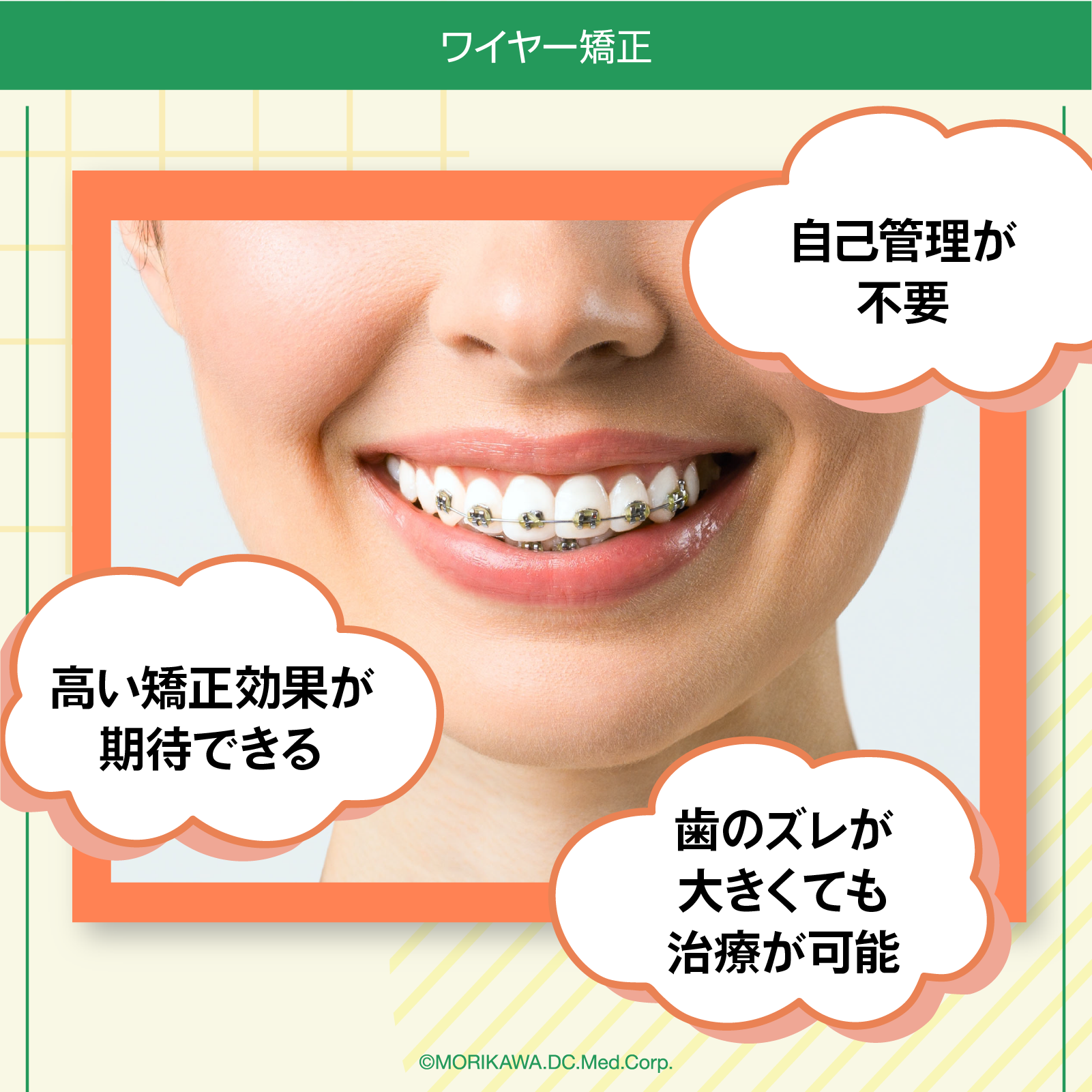 ワイヤー矯正
