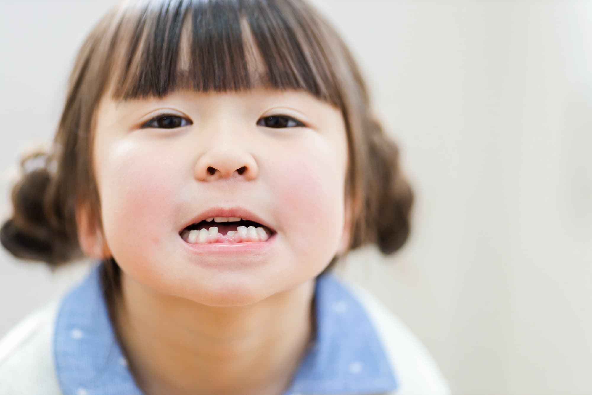 前歯が生え変わりはじめた受け口の子ども