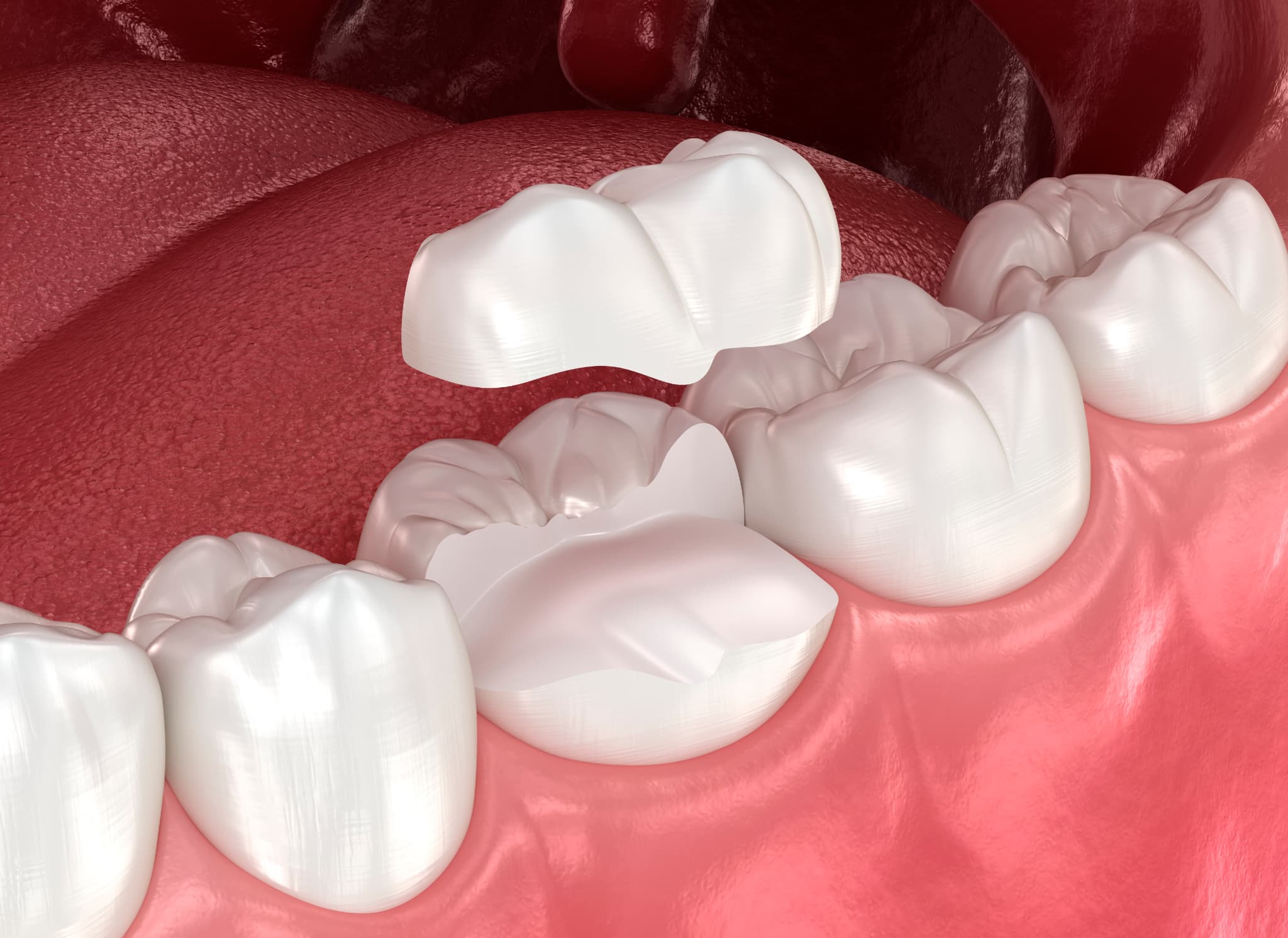 セラミックの被せ物で治療する様子