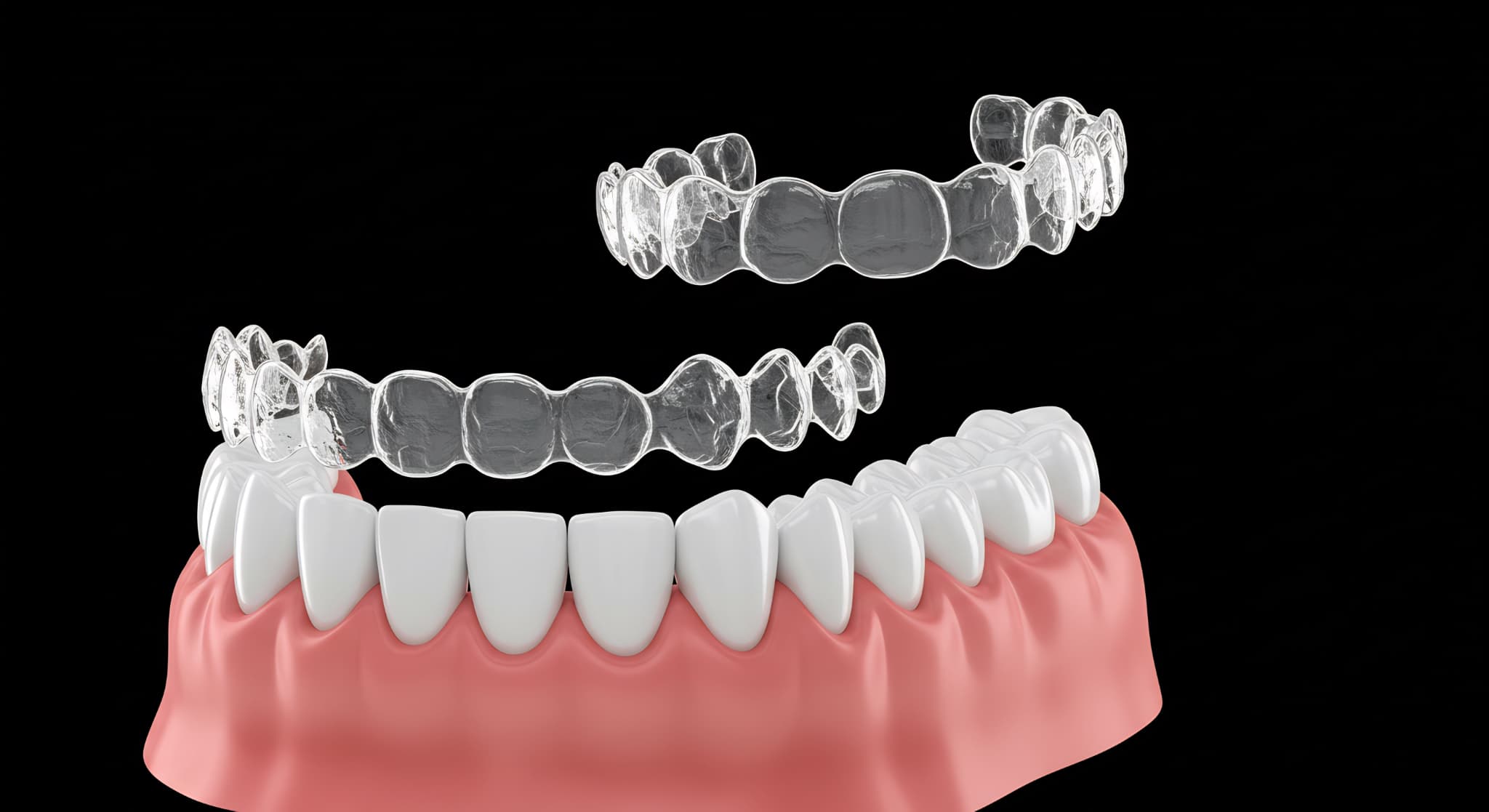 インビザラインのアライナーが歯から浮いた状態