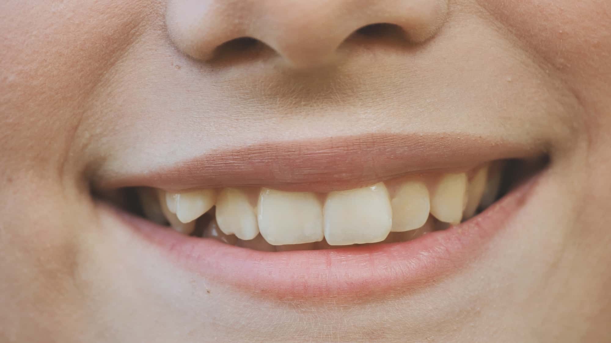 八重歯の口もとのイメージ