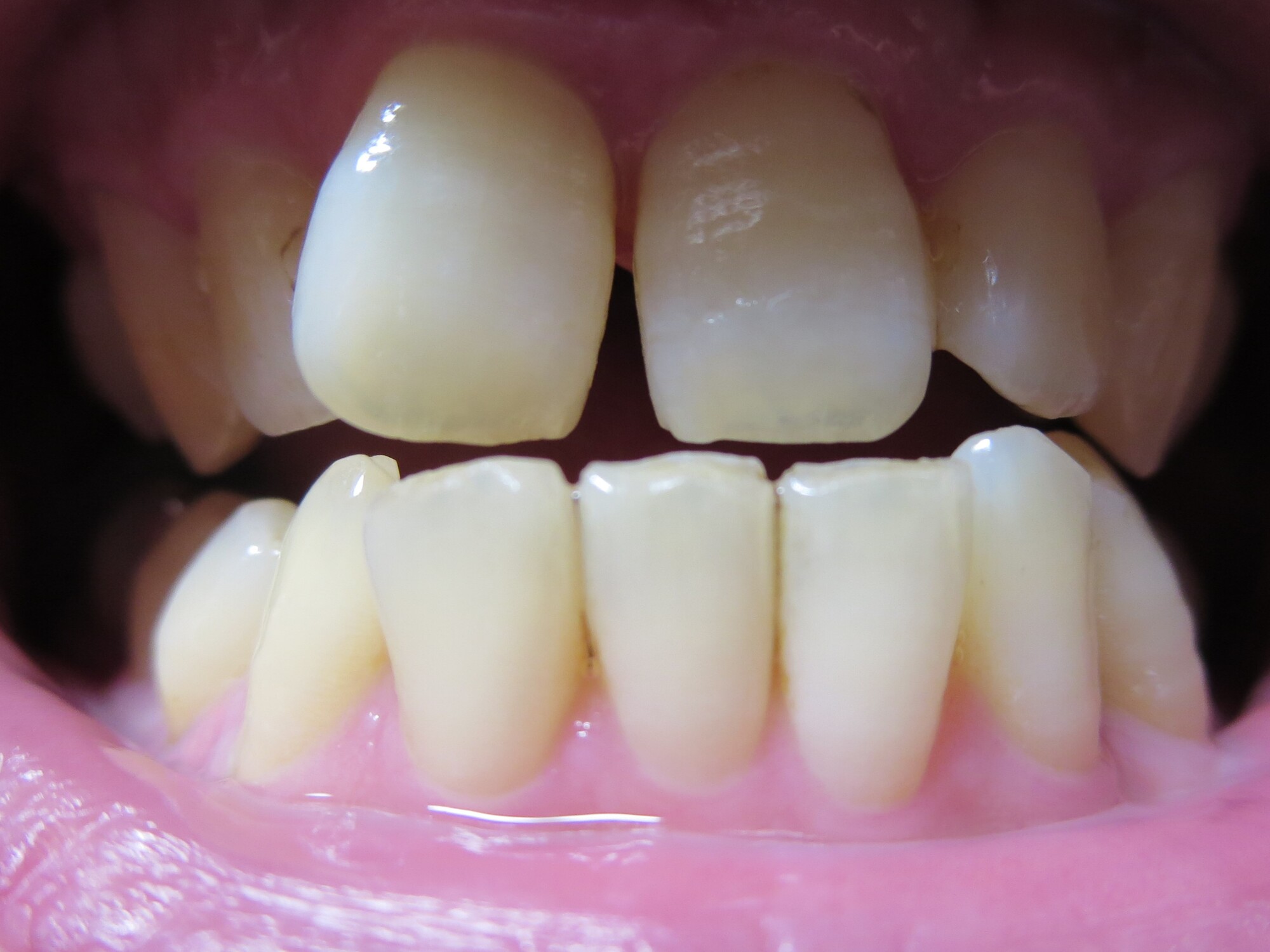 すきっ歯の人の口元