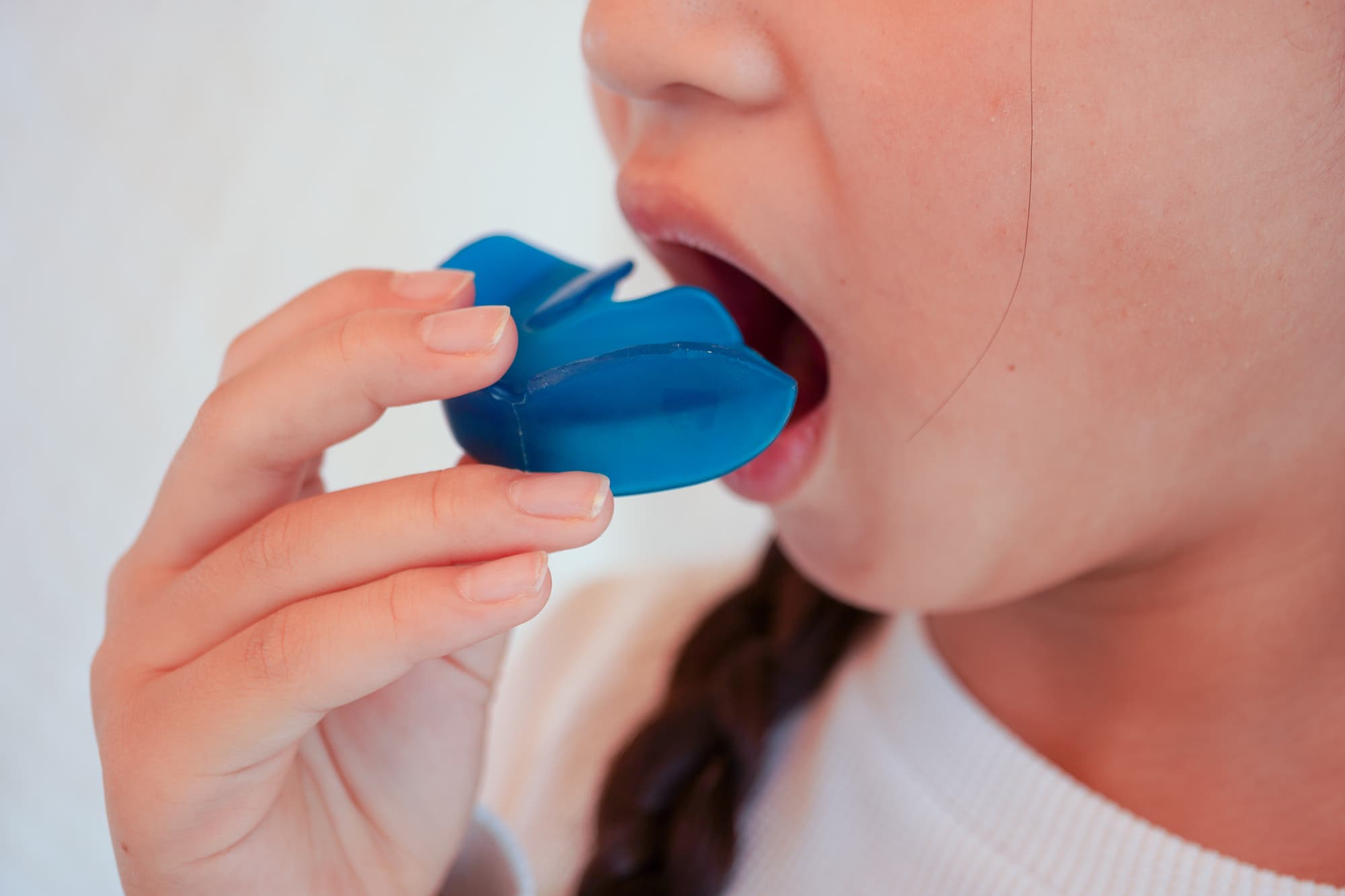 プレオルソで受け口を矯正する様子