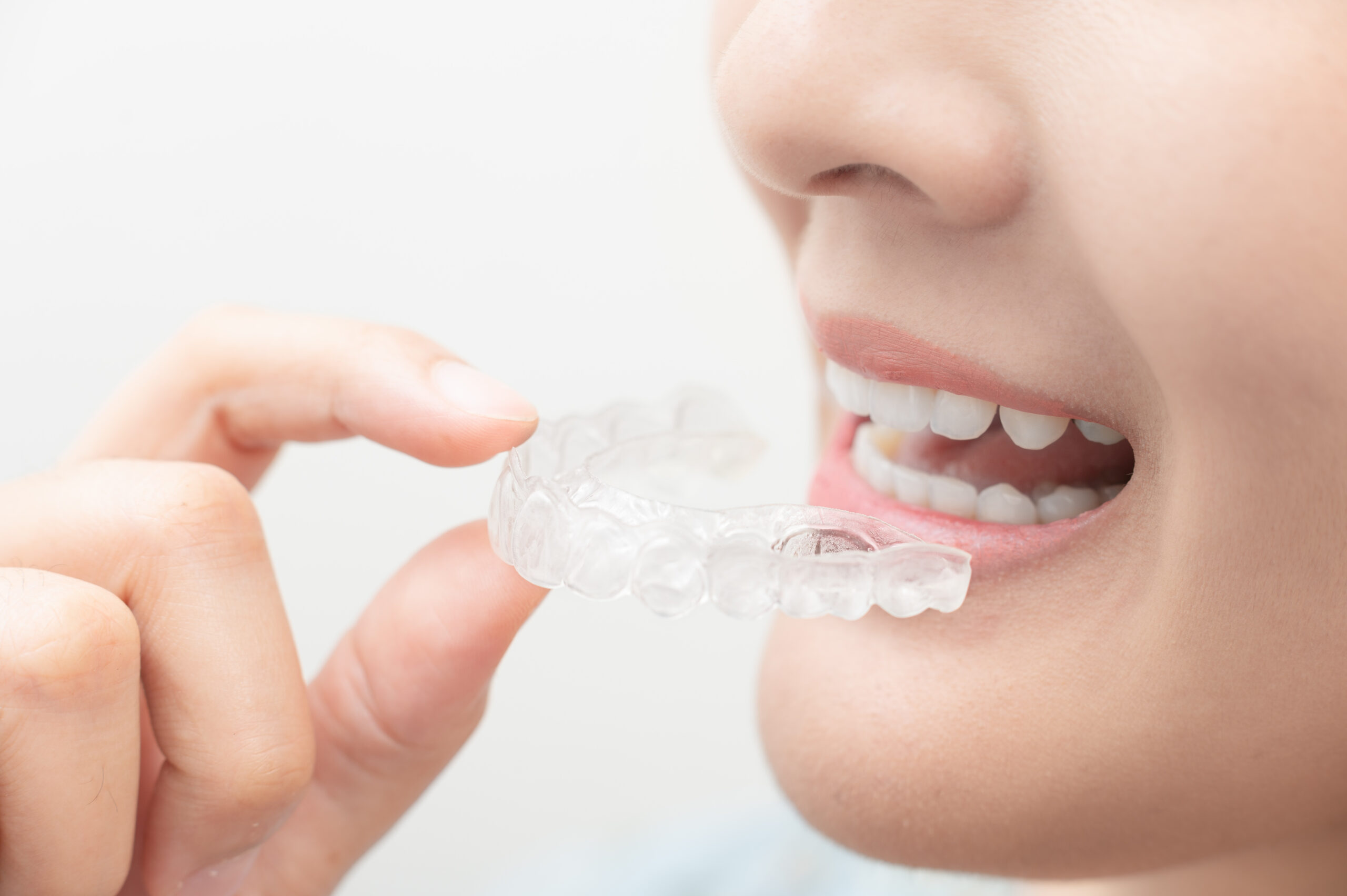マウスピース矯正治療中の女性