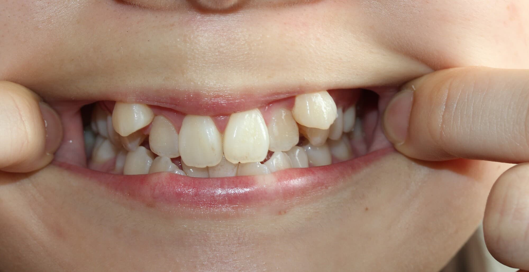 八重歯のある子どもの口