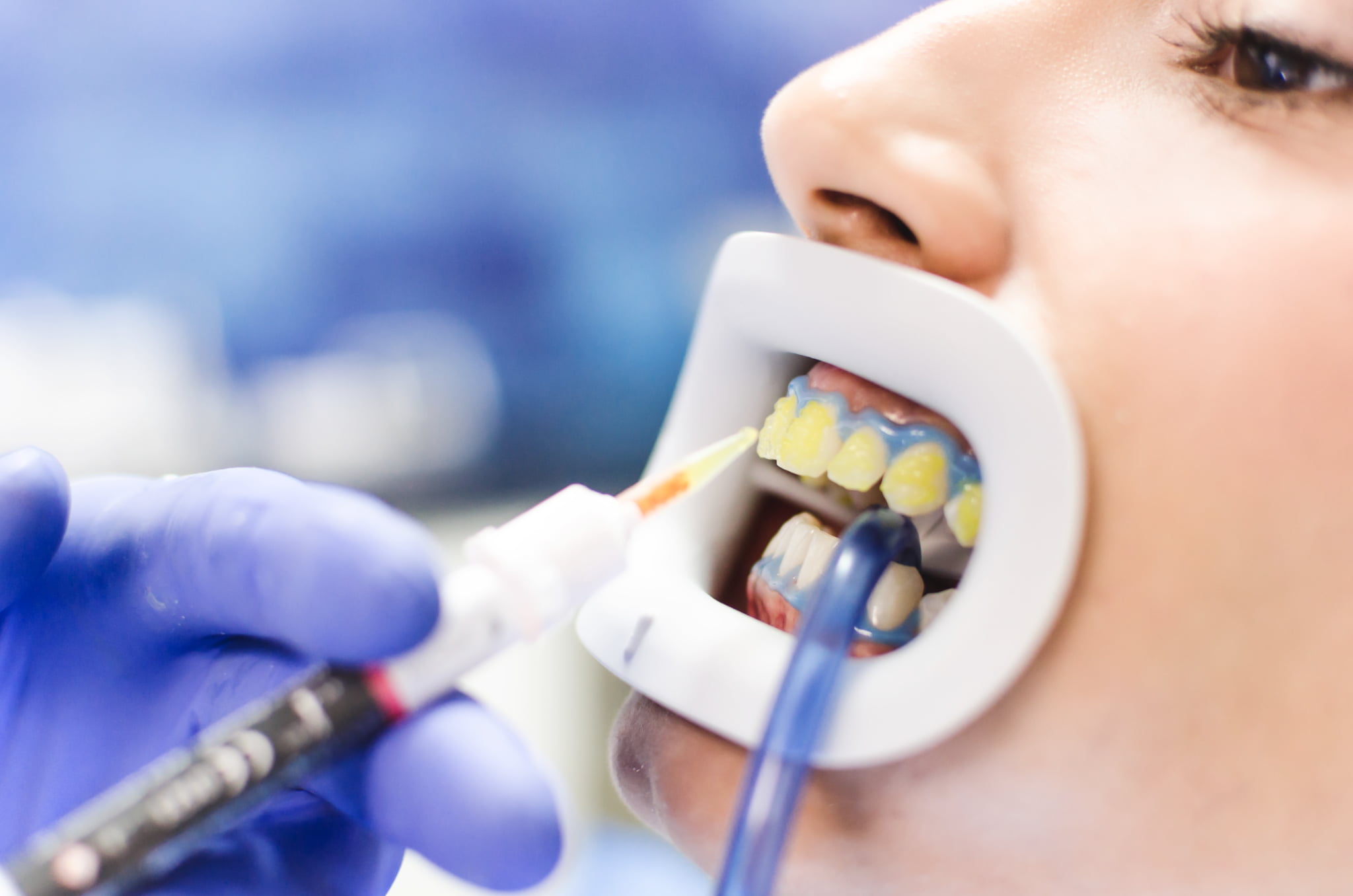 歯科医にホワイトニングの薬剤を歯に塗布されている患者